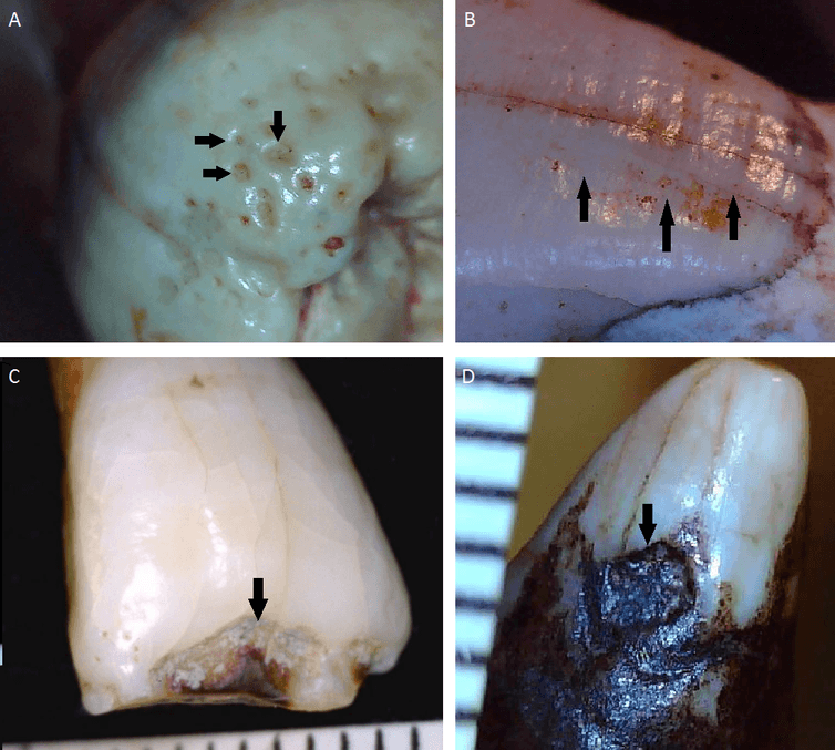 Close-ups of hypoplasia (under-development) on four teeth