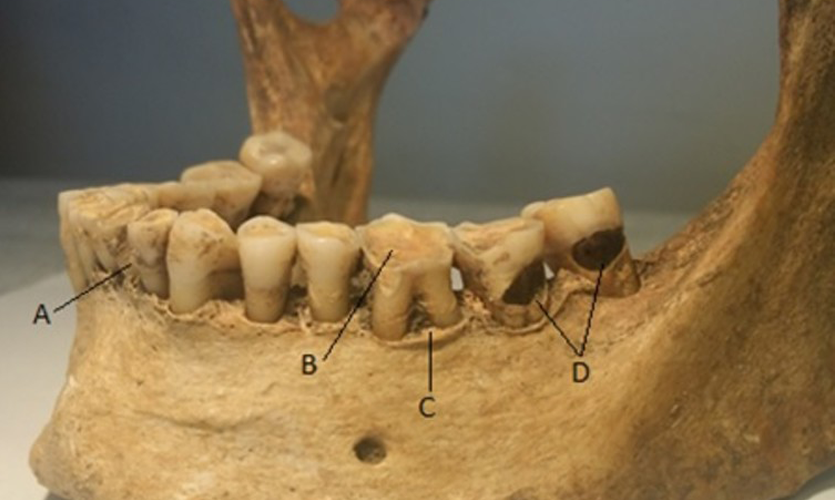 Dental pathology and wear highlighted on the jawbone of a medieval individual