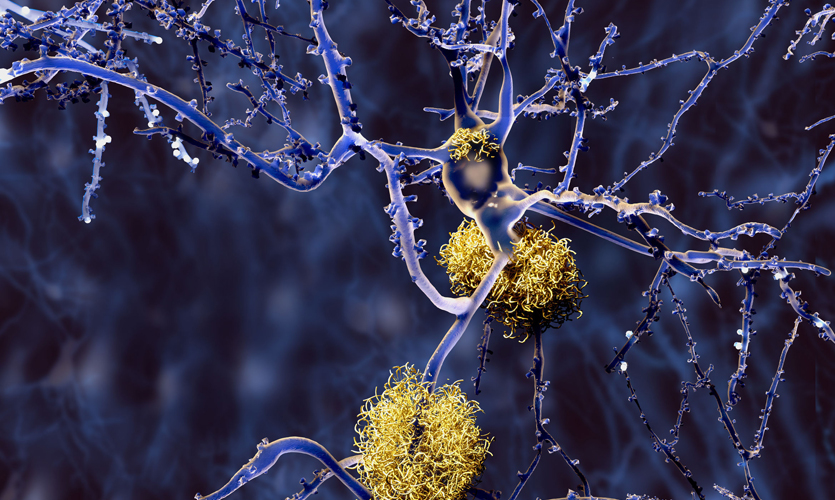 Computer-generated image of neurons with amyloid plaques, indicators of Alzheimer’s disease