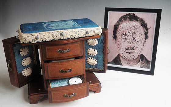 Helen Birnbaum Smallpox Quarantine Box